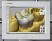 pi_cerec_3d_174